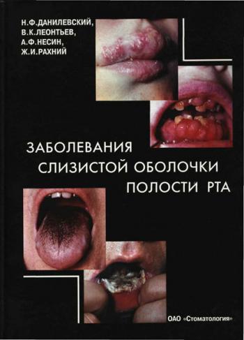 Заболевания слизистой оболочки полости рта